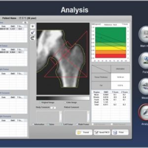 Osteodensitometru SONOST 3000