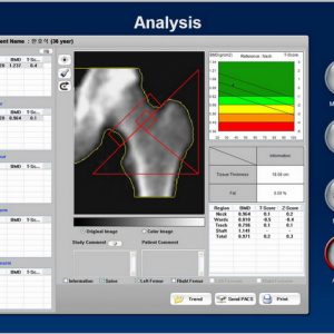 Osteodensitometru DEXXUM T